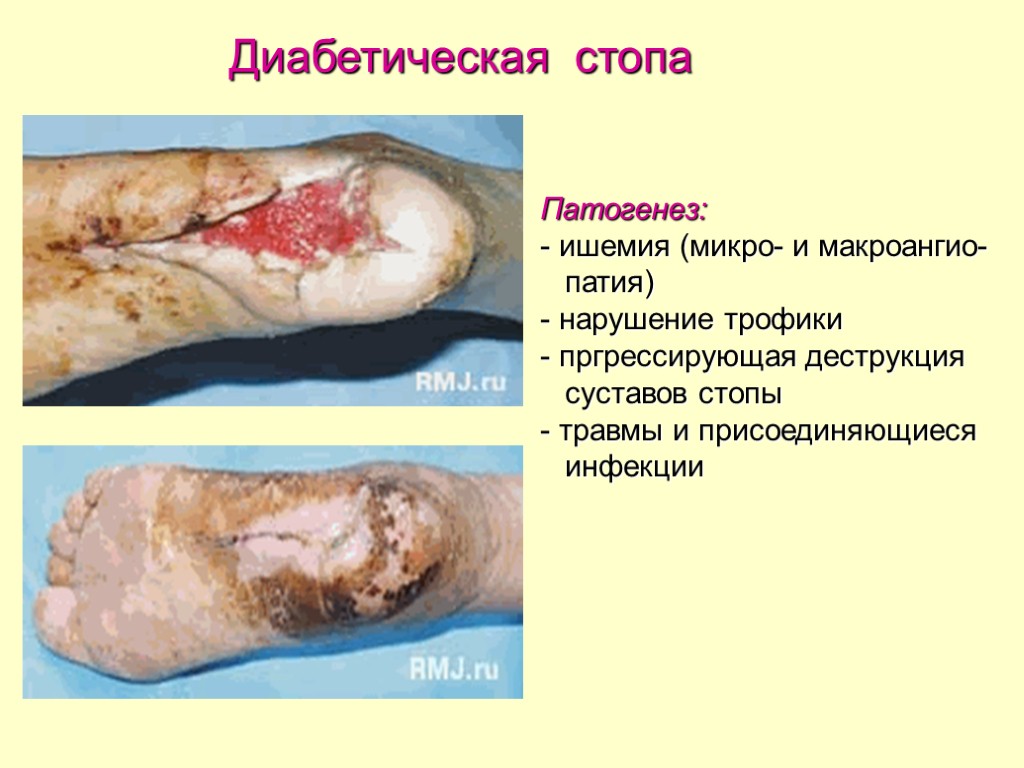 Патогенез: - ишемия (микро- и макроангио- патия) - нарушение трофики - пргрессирующая деструкция суставов